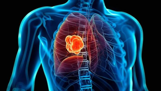 que es un nodulo pulmonar: la afeccion por la que sera operado el papa leon xiv