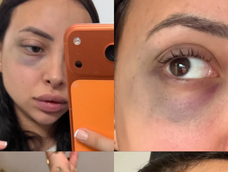 La mujer mostró en redes sociales sus lesiones.